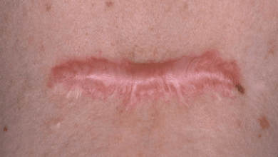 Penyebab dan Cara Menghilangkan Keloid