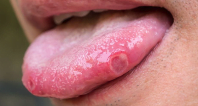 Mengobati Sariawan di Lidah
