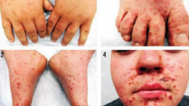 Gejala Dan Penyebab Flu Singapura