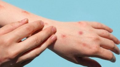 DPR Dorong Pemerintah Antisipasi Penyebaran Cacar Monyet