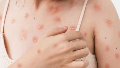 Kemenkes Sebut Kasus Cacar Monyet Belum Ditemukan di Indonesia